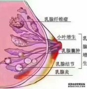 [咽部硬化症]